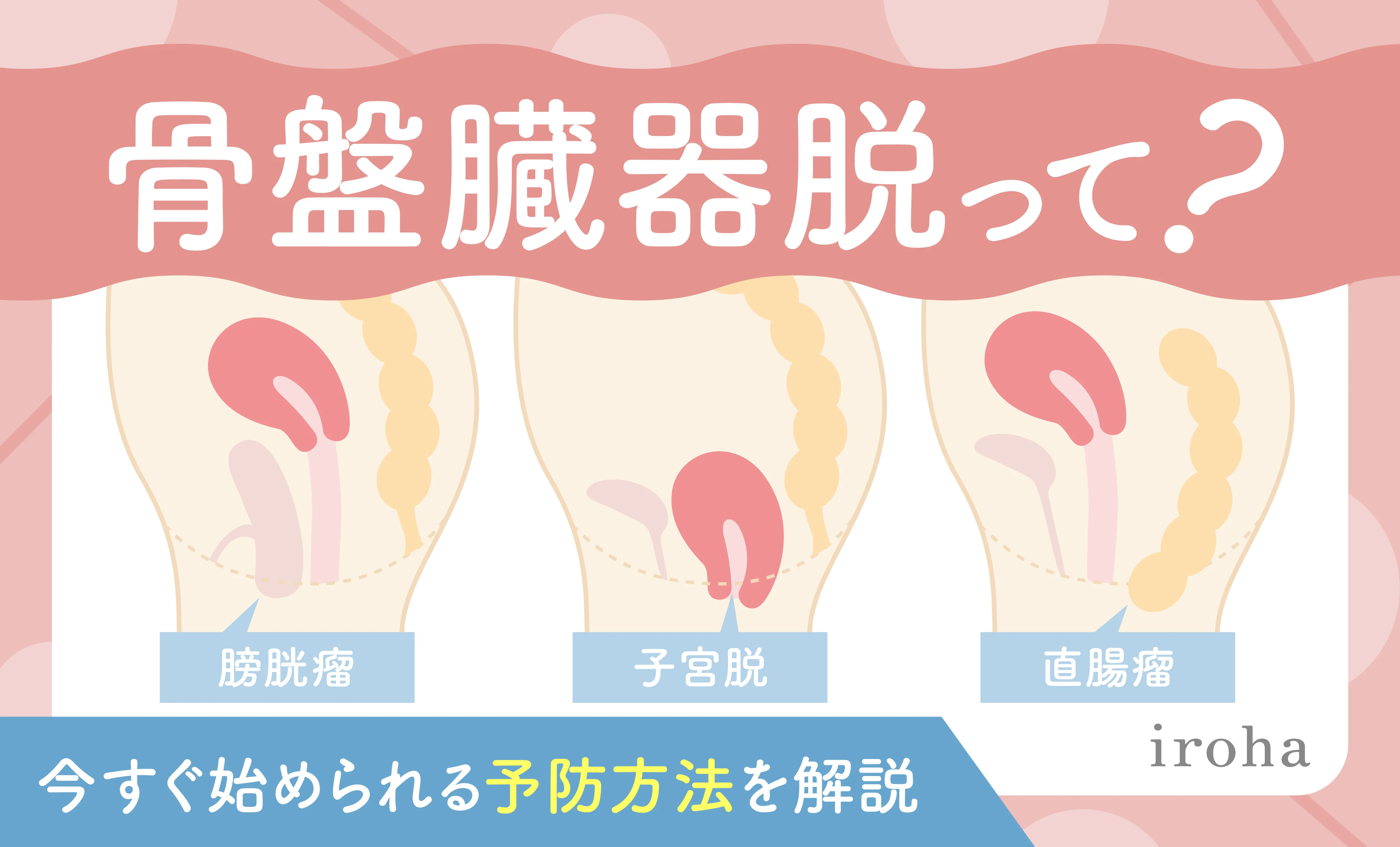 骨盤臓器脱_アイキャッチ画像