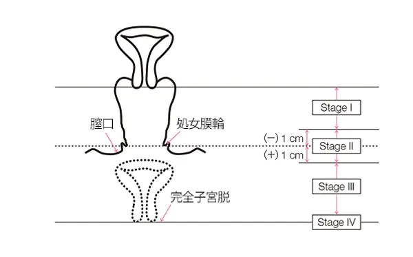 骨盤臓器脱_参考画像
