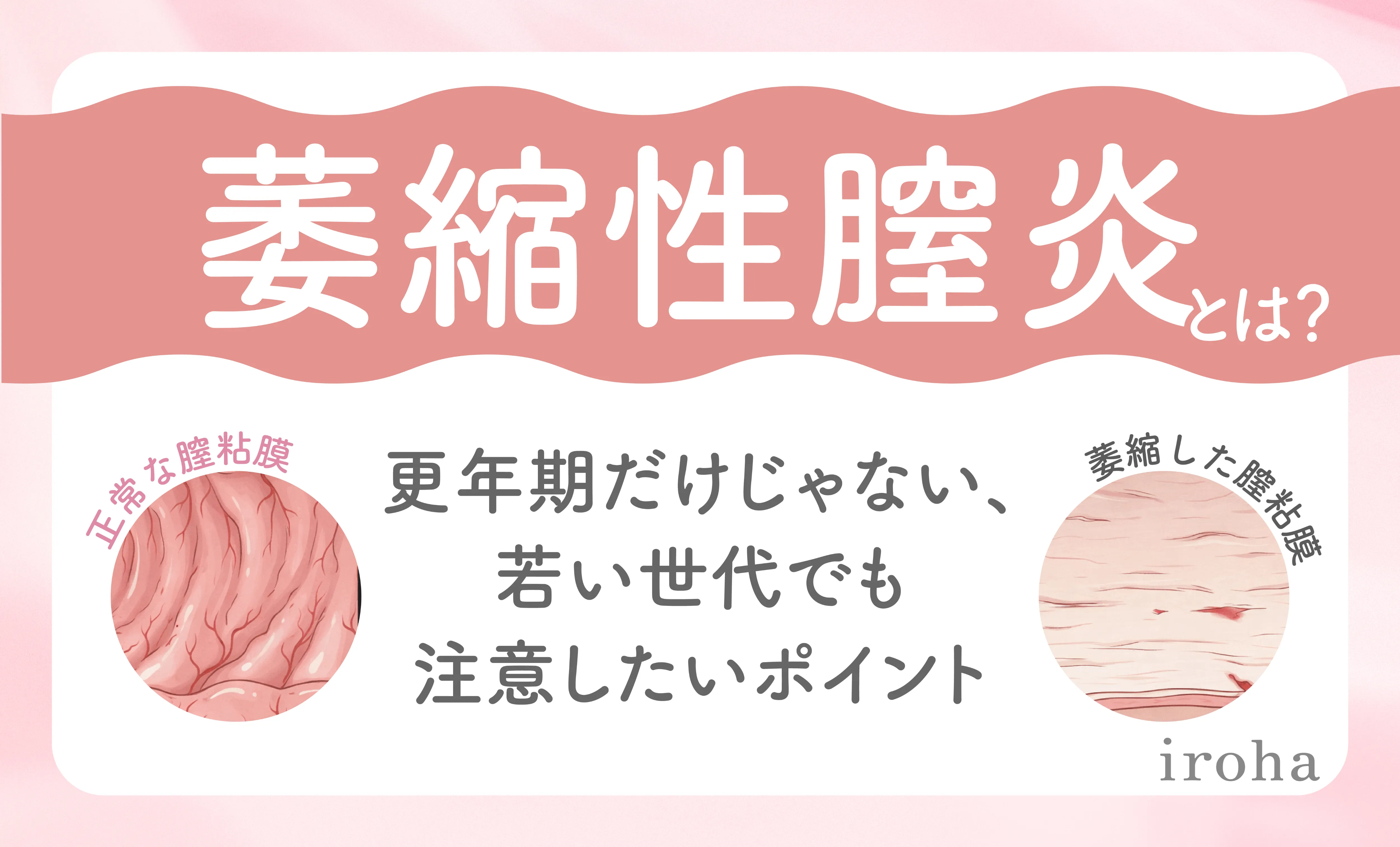 萎縮性腟炎_アイキャッチ画像