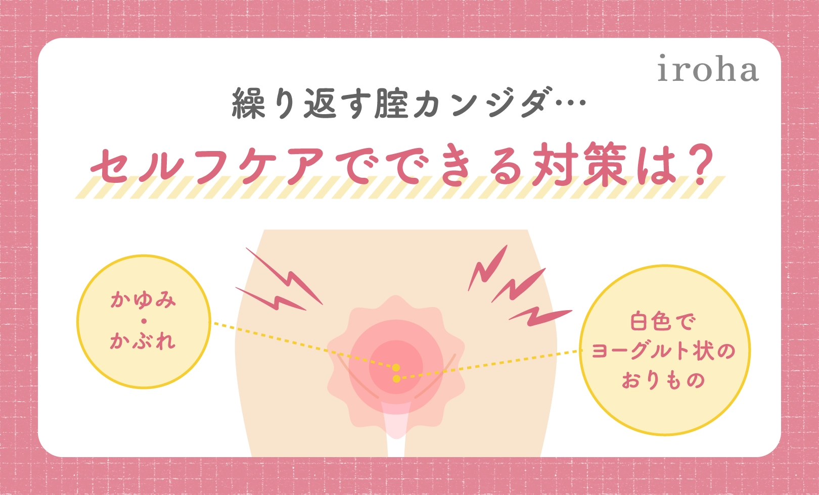 膣カンジダ_アイキャッチ画像